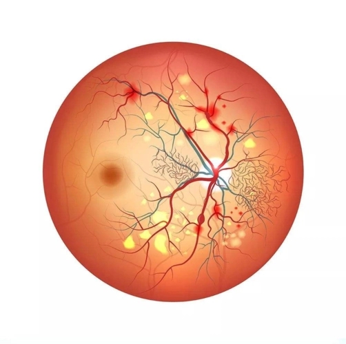 视网膜色素变形 视网膜色素变性三大症状
